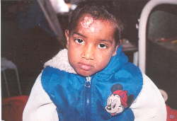 Child with HIV